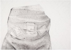 A detailed hand drawing by artist Herbert Stattler depicting a male torso one hour post-prostatectomy. The artwork captures the surgical reality of a bloated abdomen and five bandaged laparoscopic wounds with visible blood spots.
